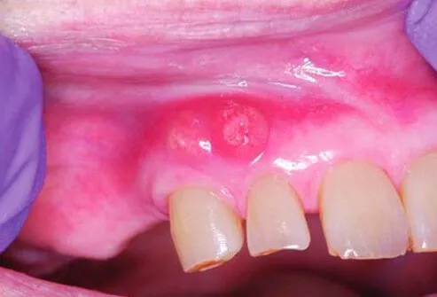 Periodontal abscesses involving 2 neighboring teeth.