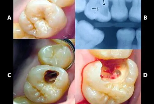 (A) A small spot of decay visible on the surface of a tooth. (B) The radiograph reveals an extensive region of demineralization within the dentin (arrows). (C) A hole is discovered on the side of the tooth at the beginning of decay removal. (D) All decay removed.