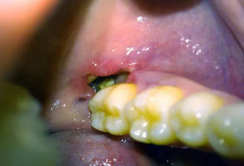 Dry socket in a patient seven days after surgery to remove tooth.