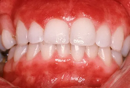 Gingivitis in a patient showing inflammation of gums.