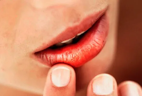 A woman with dry mouth touching her chapped lips.