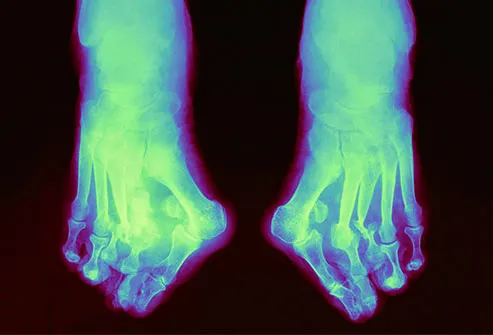 Severe neuropathy may lead to weakened bones in the feet.