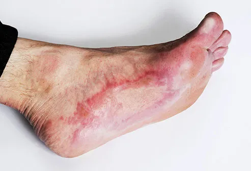 Wounds may be slower to heal with peripheral neuropathy and it increases the risk of infection. 