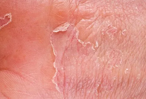 Dry, cracked skin allows bacteria and other germs to enter your body, potentially causing an infection. 