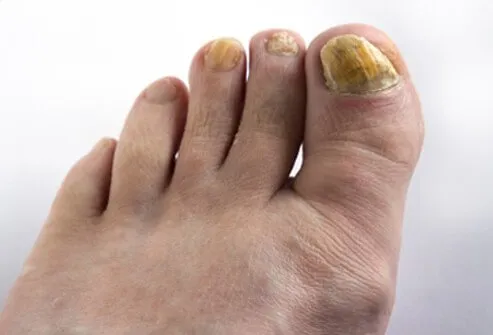 Thick, brittle, yellow-brown, or opaque nails are common with fungal nail infections.