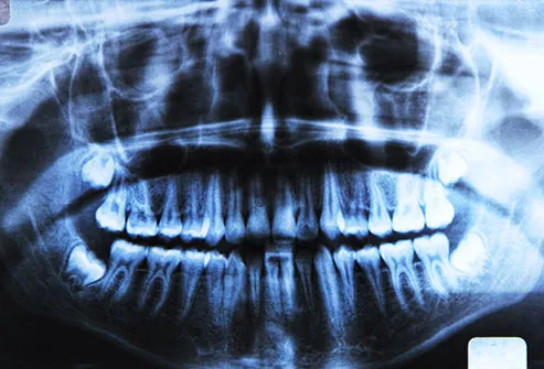 Low doses of X-ray radiation increase the risk of cancer by a small amount.