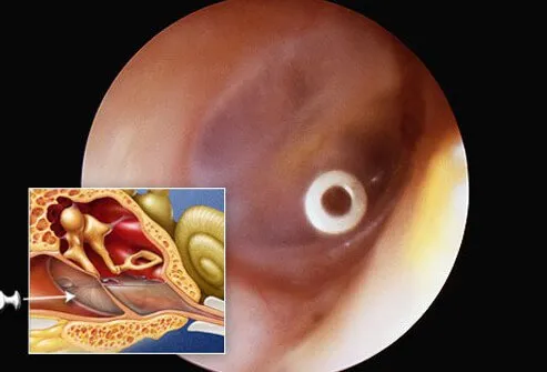 Tympanostomy tubes are small tubes that are sometimes inserted in the eardrums of children who have frequent ear infections.