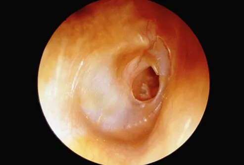 When the pressure from fluid buildup is too high inside the middle ear, the eardrum can rupture, as shown here.