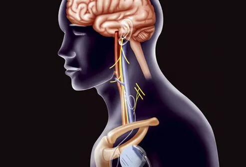 VNS or vagus nerve stimulation is a treatment technique designed to prevent seizures by sending regular, mild pulses of electricity to the brain by stimulating the vagus nerve.