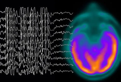 Most people equate epilepsy with convulsions, but epileptic seizures can produce many different symptoms; two large groups of seizures are termed partial and generalized.