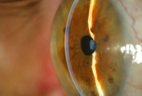 Glaucoma is increased pressure inside the eye. 