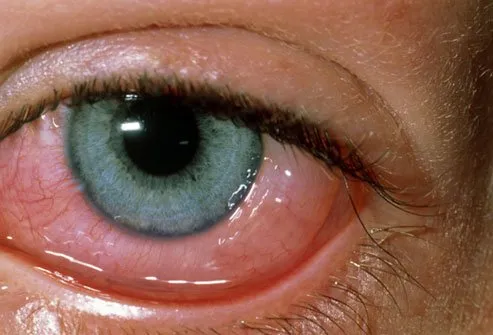 Pet dander, dust mites, and pollen are some of the causes of red eyes.