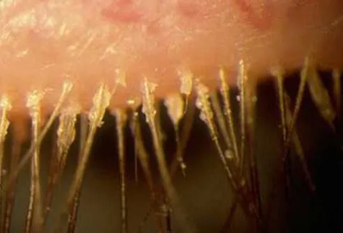 Blepharitis is inflammation of the eyelids. 