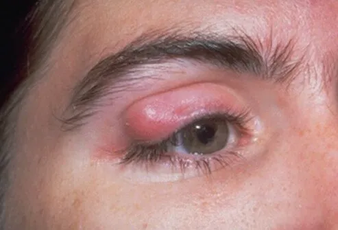 A chalazion (also called a meibomian cyst, tarsal cyst, or conjunctival granuloma) is the inflammation of a small cystic gland in the eyelid.