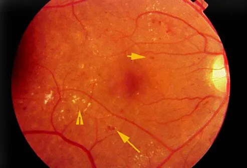 People with diabetes often have problems with their blood vessels throughout their bodies and the eye is no exception.