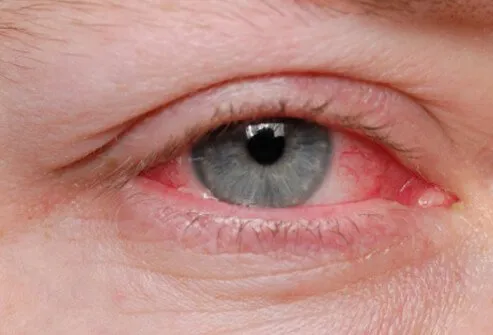 Severe eye allergies may cause damage to the eye that may threaten eyesight. 