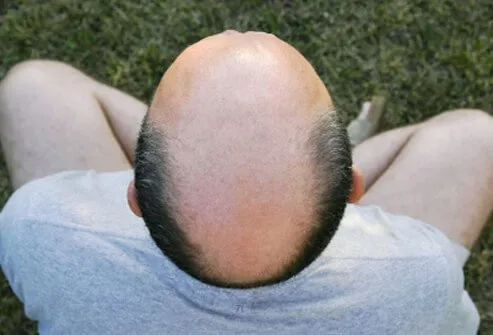 Androgenetic alopecia, also sometimes referred to as 