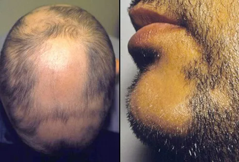 Alopecia areata (AA) is a common form of hair loss. 