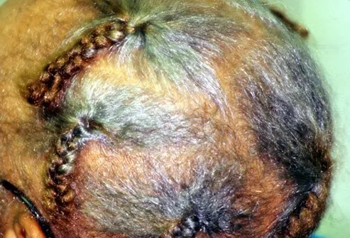 Traction alopecia is caused over time by constant pulling on hair roots.