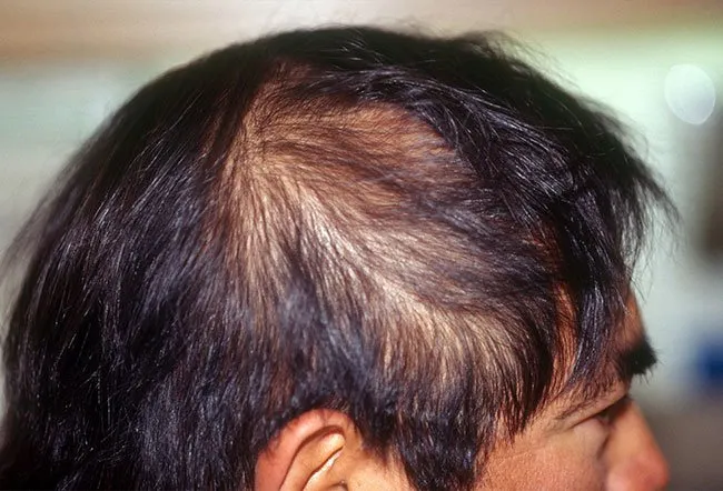 Telogen effluvium (TE) is a thinning of the hair on the scalp, not necessarily evenly. Hair growth involves several phases.