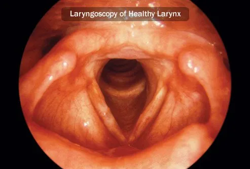 Pharyngeal cancer is cancer on the back of your throat.