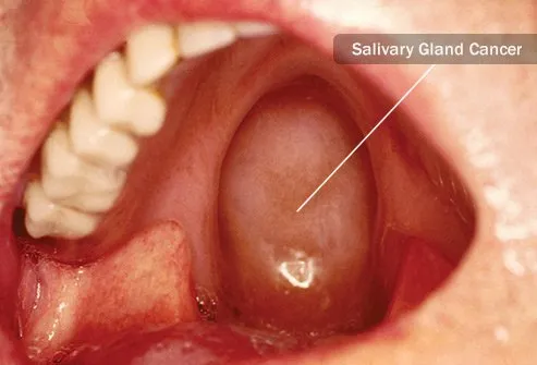 This rare cancer affects the glands that let you salivate.