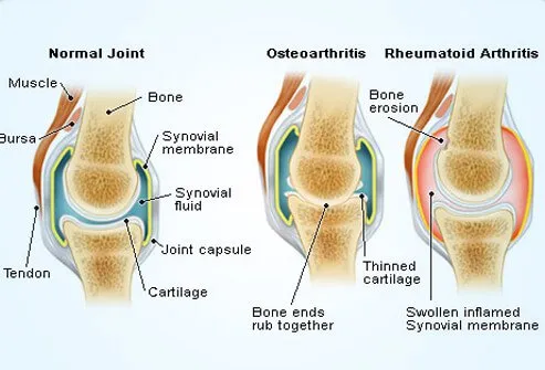 An illustration showing the differences between a normal, healthy joint, a joint affected by osteoarthritis, and one affected by rheumatoid arthritis.