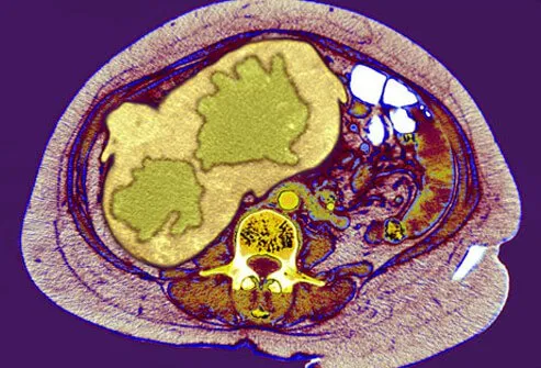 Hepatitis B and hepatitis C are leading causes of liver cancer. 