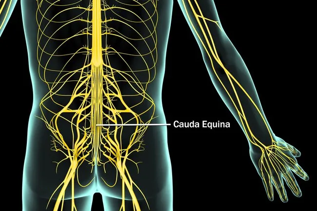 A herniated disk in the area of the cauda equina may be associated with more serious complications.