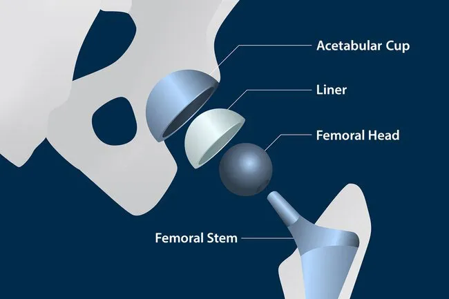 The new hip has a metal stem that connects into your thighbone.