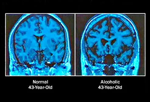 Long-term heavy drinking is associated with a shrinking brain. 