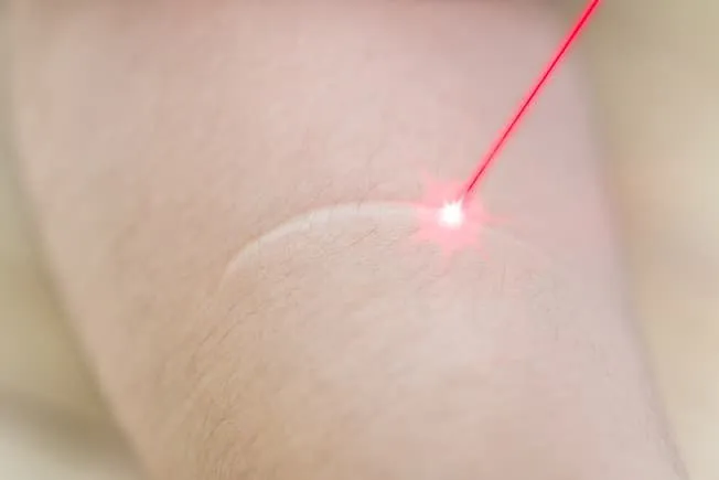 Like chemical peels and dermabrasion, laser therapy is for severe scars