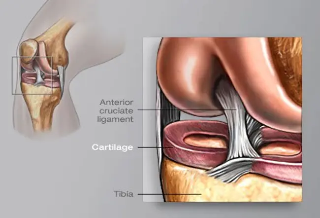 Knee replacement surgery can help with severe arthritis pain and may help you walk easier too.