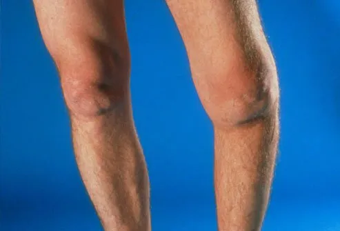 Knee replacement surgery may help you if other arthritis treatments do not work.