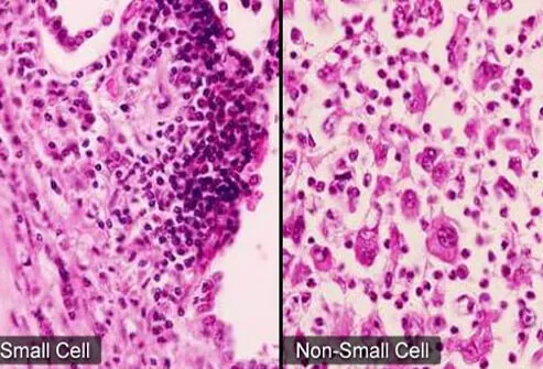 There are only two major types of lung cancers: small cell lung cancer and non-small cell lung cancers.