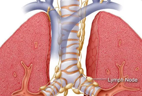 After the type of lung cancer is determined, the type is then assigned a lung cancer stage.