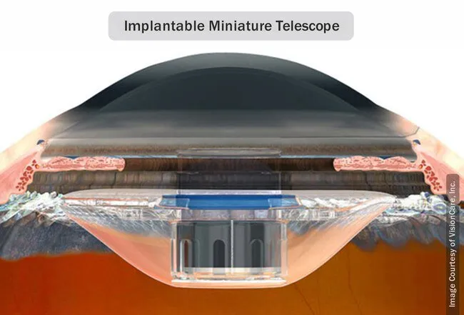 A small telescope may be placed in the eye in select cases of advanced dry macular degeneration.