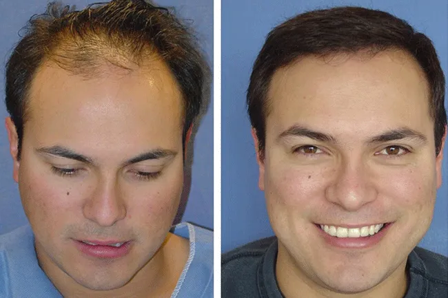 Hair transplant is one treatment option for thinning hair.