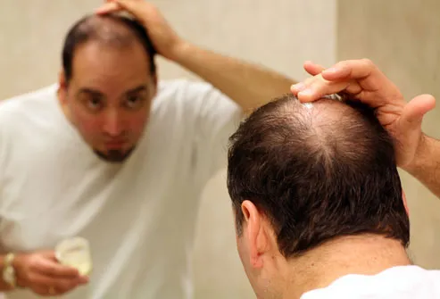 Minoxidil may help slow the rate of hair loss, but you have to use the product continuously.