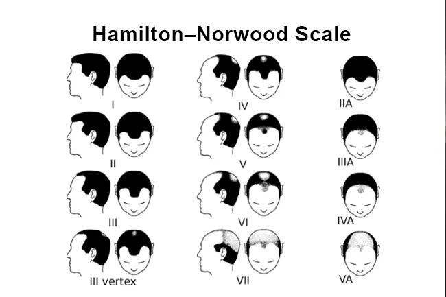 Male-pattern baldness proceeds in a predictable pattern as shown by the Hamilton-Norwood scale.