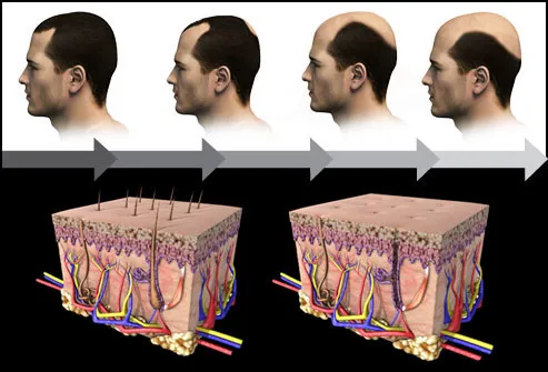 The hormone DHT causes follicles to shrink and inhibits hair growth.