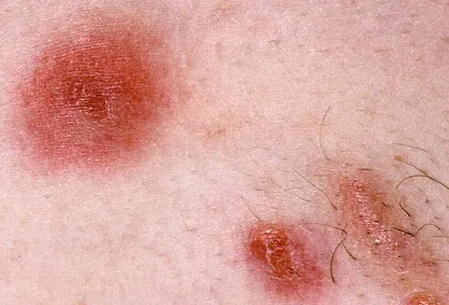 MRSA skin infection.