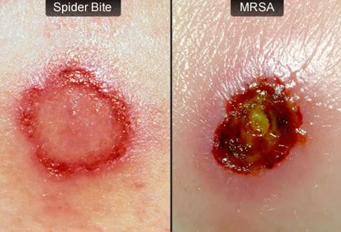 Bug bites, insect bites, spider bites, rashes, and stings are often difficult to distinguish from MRSA infections because they have similar appearances or symptoms.