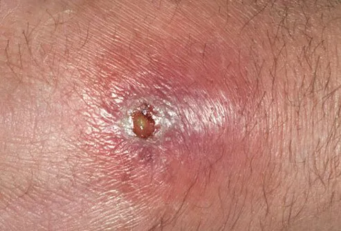 This deeper skin infection is termed an abscess and can spread like cellulitis in some instances.