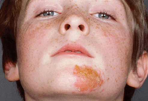 While the infection is more common in people over 50, anyone who's had chickenpox can get it, even children.