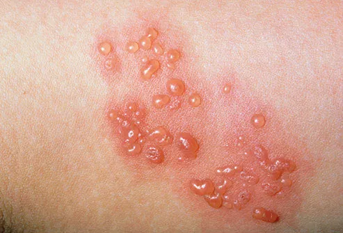 The open blisters of the rash can't pass on shingles, but they can spread the chickenpox virus to someone who's never had it.