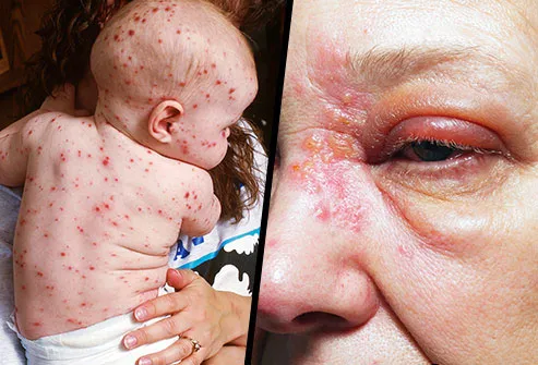 They're caused by the same virus, but shingles and chickenpox are not the same illness.