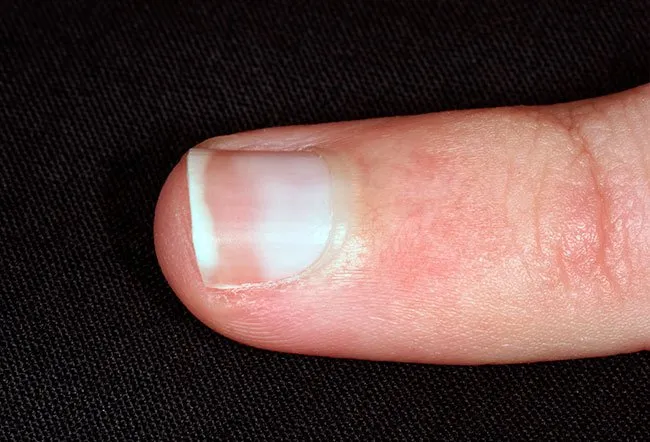 Pale nails can indicate more serious health problems in some individuals.