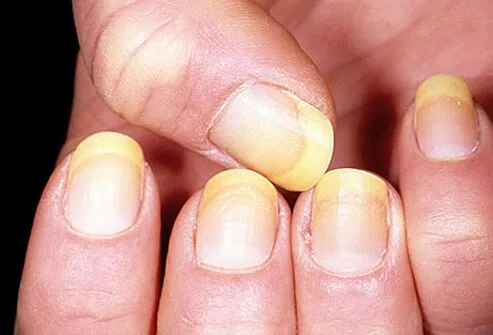 Nail diseases may include fungal infections or other conditions, which cause yellow nails.