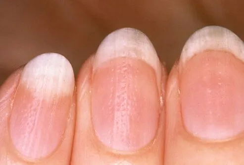 Nail pitting is a classical sign of psoriasis in the nail.